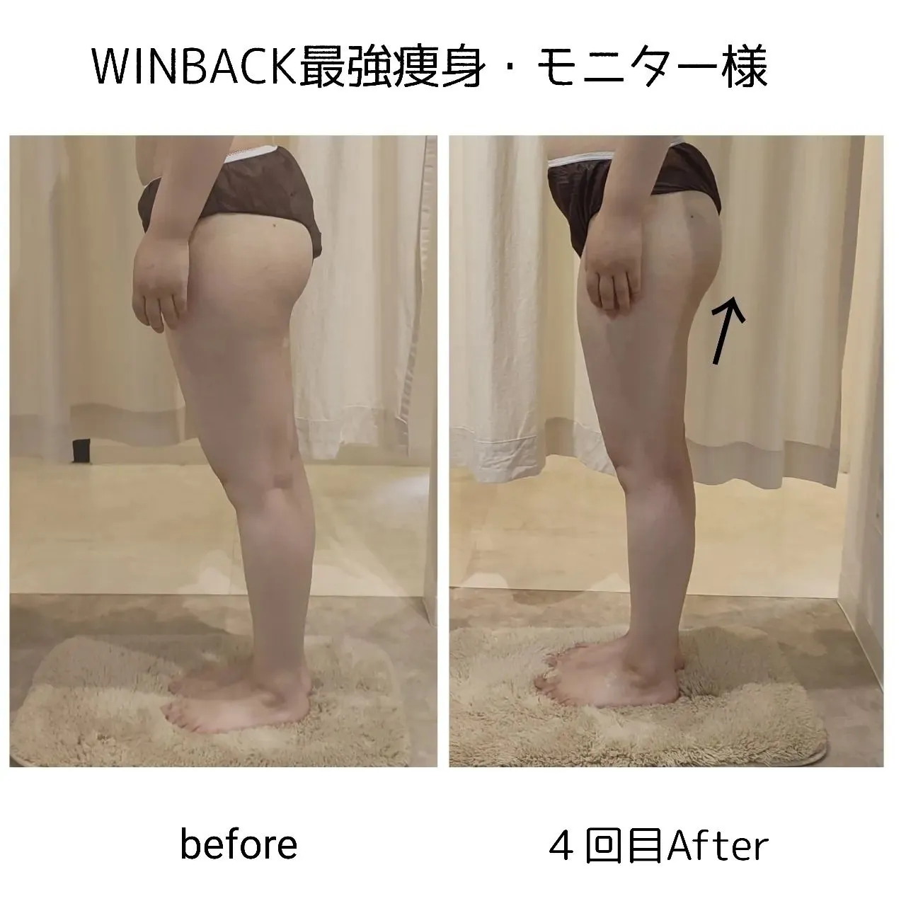 WINBACKの高周波×低周波×中周波EMSで最強痩身！