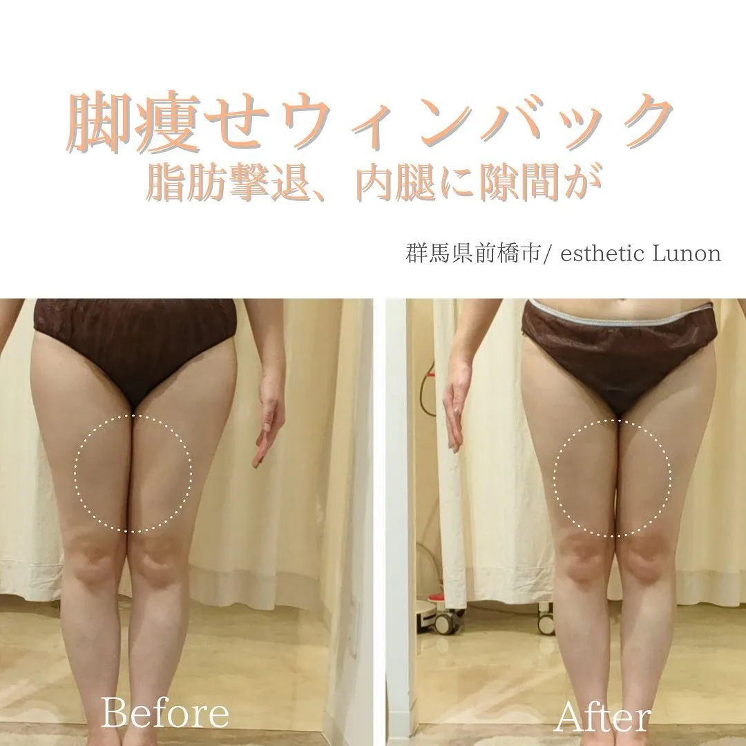 ウィンバック2回のお客様before×after