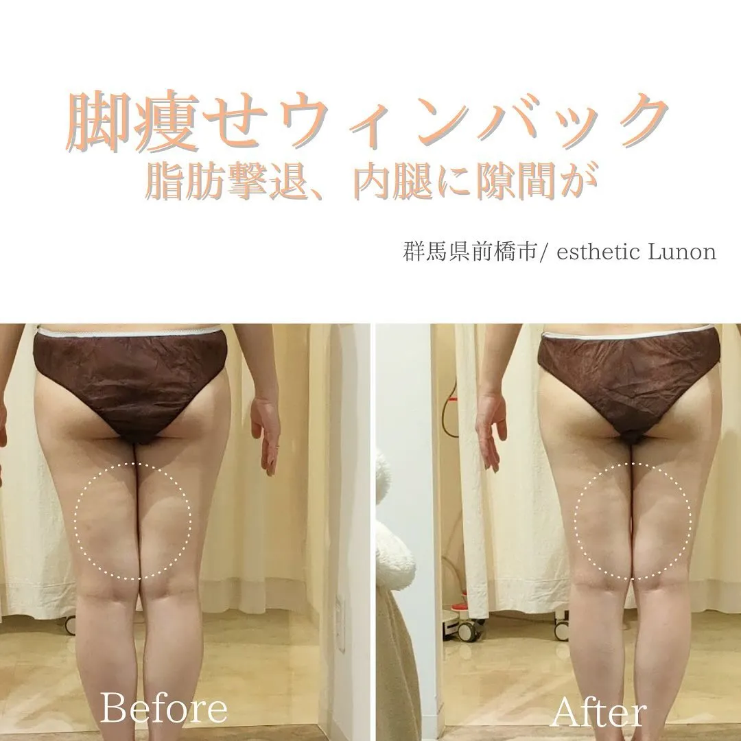 ウィンバック2回のお客様before×after