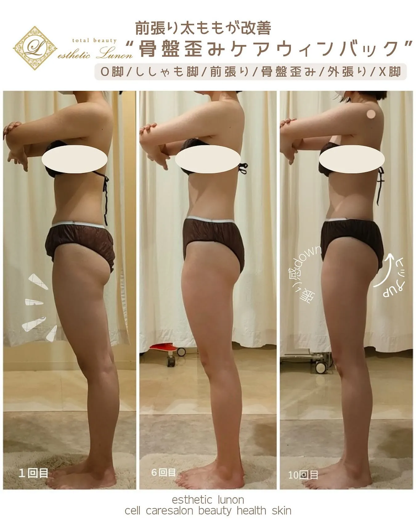 前張り、外張り太ももに悩む方多いです！