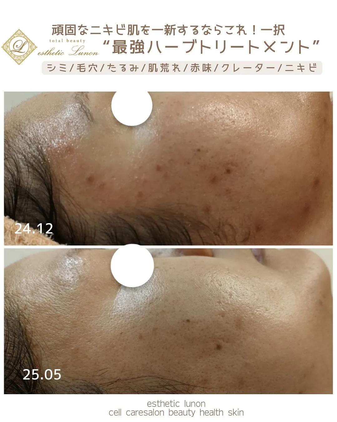 繰り返し同じ場所にニキビが出来てしまっていた