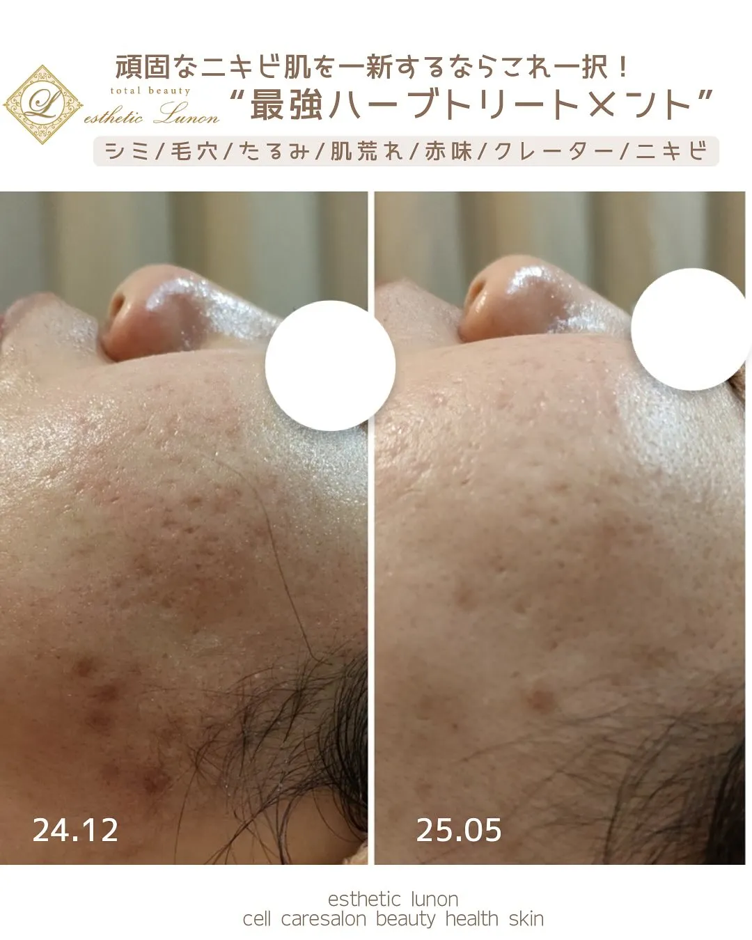 繰り返し同じ場所にニキビが出来てしまっていた