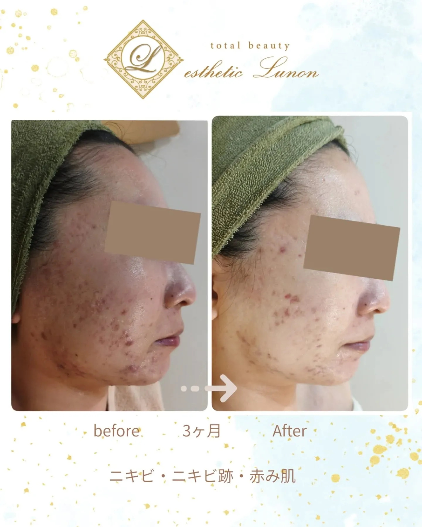 【ニキビケア】