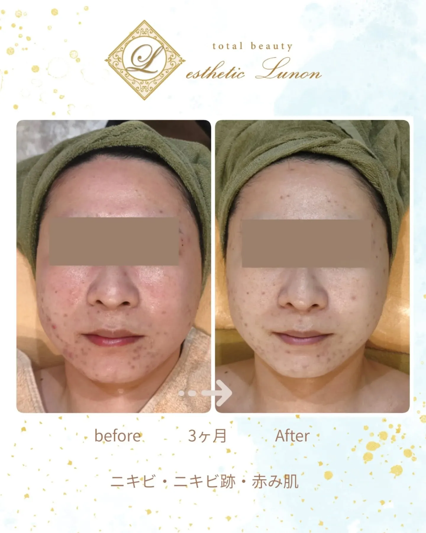 【ニキビケア】