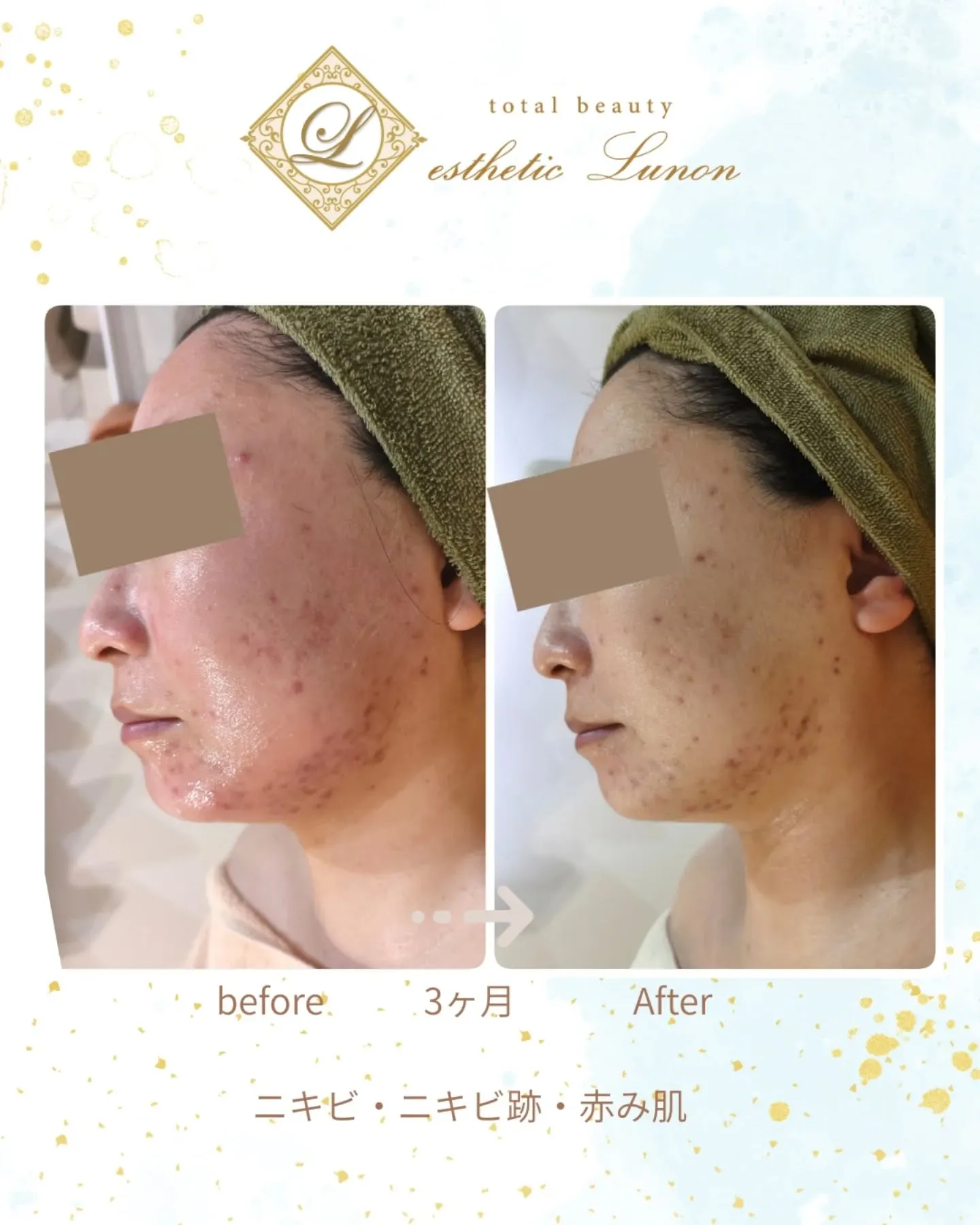 【ニキビケア】